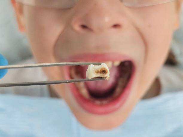 Best Emergency Dental Care for Broken or Chipped Teeth in Reedley, CA